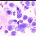 Αδενικά κύτταρα με αρραιοχρωματικούς ανισομεγέθεις πυρήνες, επίχρισμα του 2003